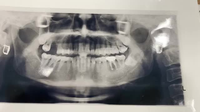Ca gắn răng implant 16 cho khách hàng tại Nha Khoa Thuỳ Anh.