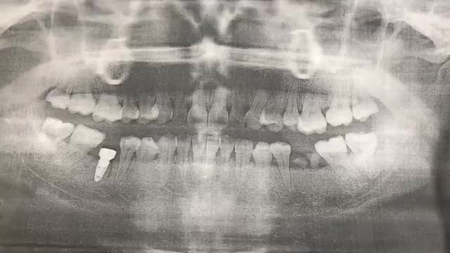Ca lắp răng implant vị trí số 46 cho khách hàng tại Nha Khoa Thùy Anh.
