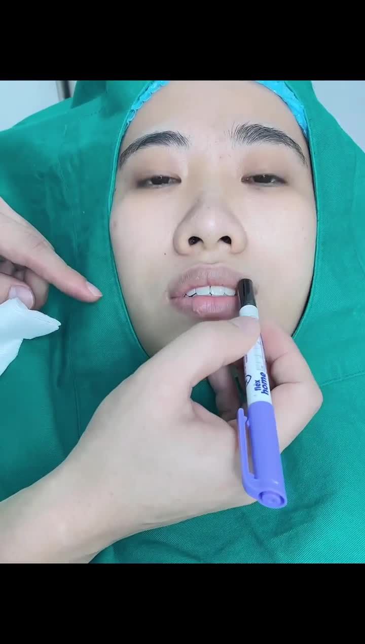 ca tạo hình môi tim Lips Perfect mang đến một đôi môi nhỏ gọn, mềm mại, xinh xắn với bàn tay khéo léo của bác sĩ tại Tấm.