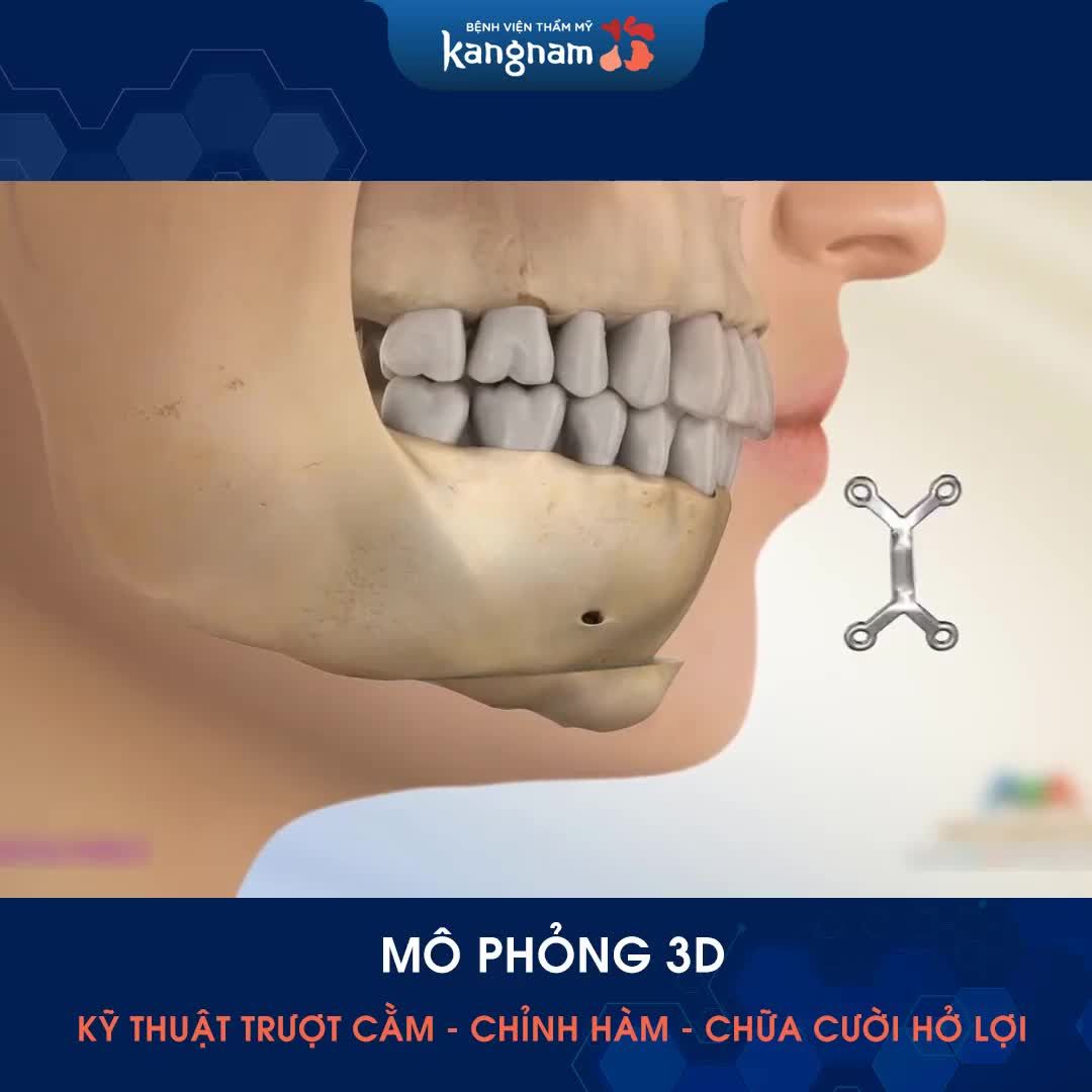 Cằm ngắn lẹm - Hàm hô móm - Cười hở lợi Chỉnh sửa như thế nào?