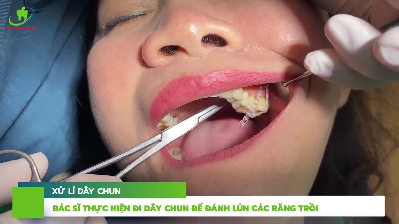 CẮM VÍT ĐÁNH LÚN RĂNG HÀM BỊ TRỒI LÊN DO MẤT RĂNG HÀM ĐỐI DIỆN