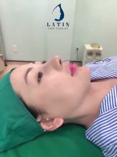 Case mũi sửa lại cấu trúc sóng surgiform dáng cao tây cho KH từ Cà Mau lên Sài Gòn làm đẹp.