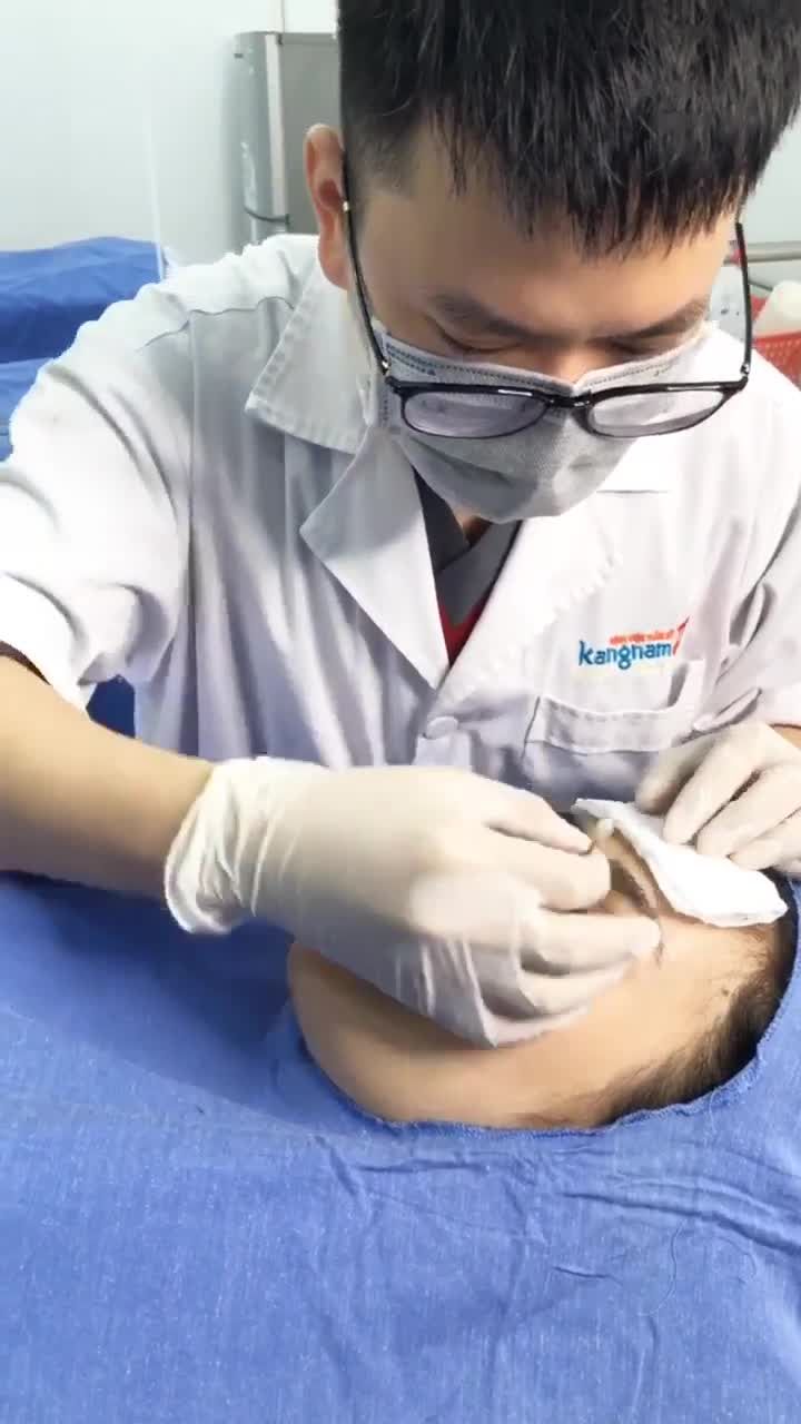 Cắt mí SAU BAO LÂU có thể cắt chỉ️ Quy trình cắt chỉ mí có đau không️
