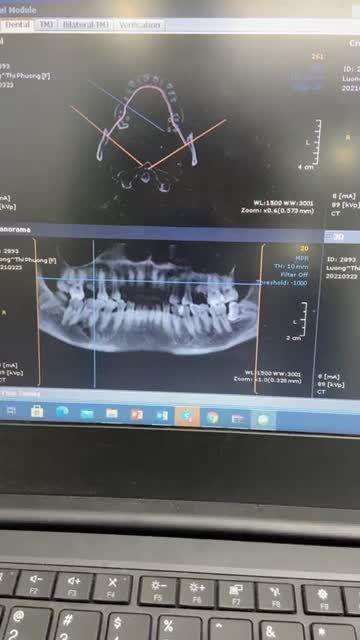 Cấy ghép implant Dentium Hàn Quốc cho khách hàng tại Kim Mã