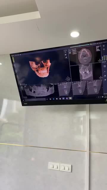 CẤY GHÉP IMPLANT KHÔNG ĐAU CHỈ CÓ TẠI NHA KHOA LẠC VIỆT INTECH