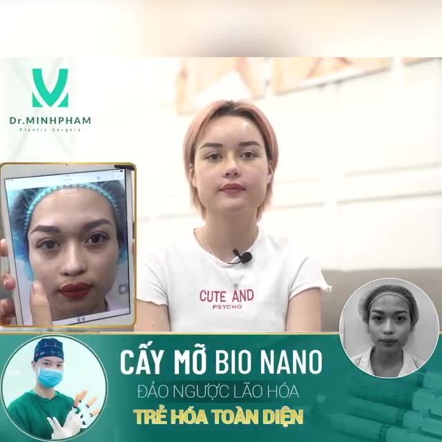 "CẤY MỠ MẶT " ĐẢO NGƯỢC LÃO HÓA . TRẺ HÓA XÓA NHĂN
