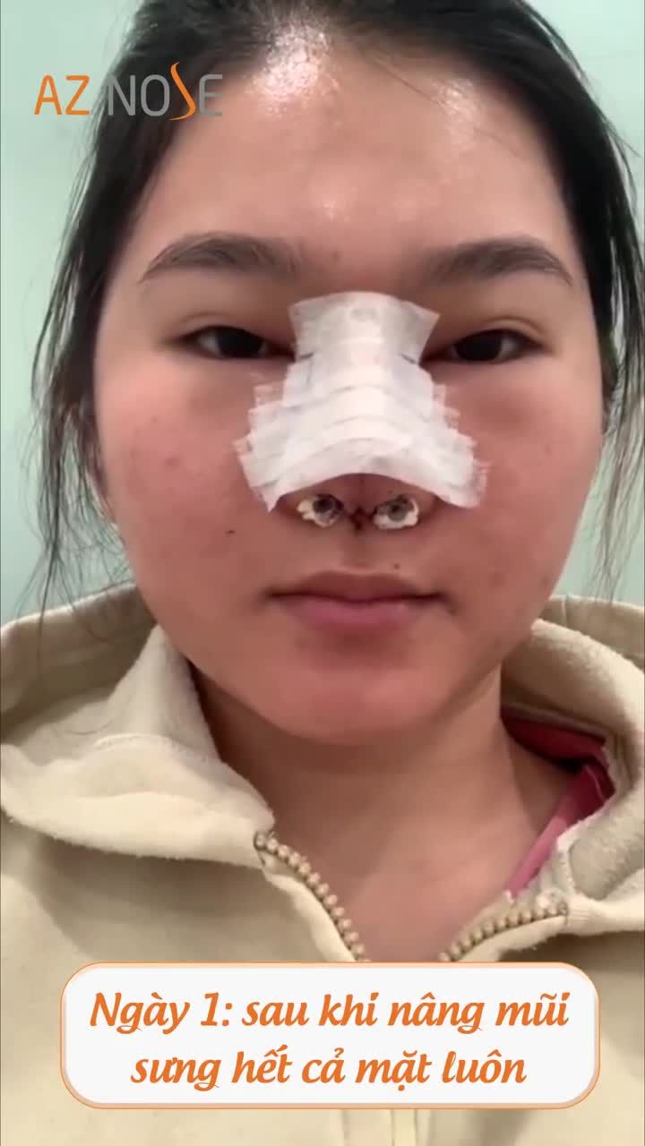 Chiếc Clip ghi lại hành trình 12 ngày nâng mũi được thực hiện bởi chính khách hàng AZ NOSE.