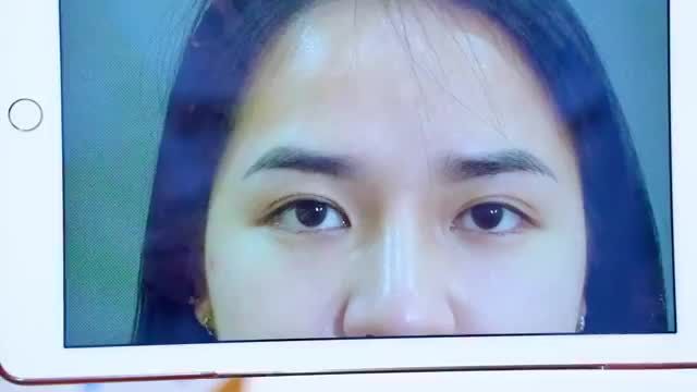 Chiêm ngưỡng ngay "tác phẩm" sau cắt mí của chị khách hàng dưới đây để cùng chứng thực về tính ưu Việt của công nghệ cắt mí tại VTM Dr.Hải Lê!