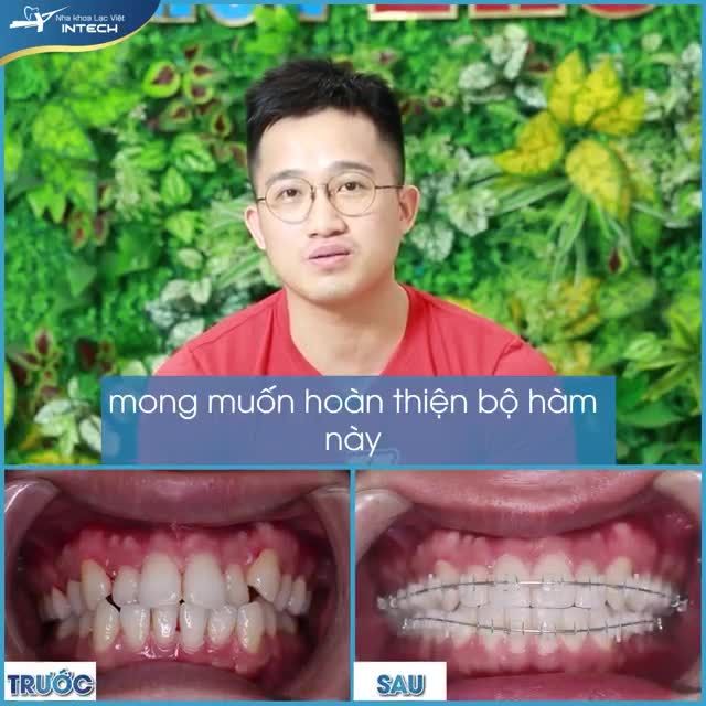 “CÔNG VIỆC, CUỘC SỐNG CỦA MÌNH THUẬN LỢI HƠN RẤT NHIỀU SAU KHI NIỀNG RĂNG KHẤP KHỂNH”