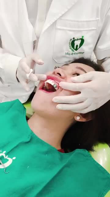 DÁN SỨ VENEER BỀN CHẮC THEO THỜI GIAN, ĂN NHAI ĐẾN TRỌN ĐỜI