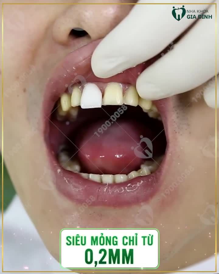 DÁN SỨ VENEER – GIẢI PHÁP LÀM ĐẸP AN TOÀN KHẮC PHỤC HOÀN HẢO CÁC KHUYẾT ĐIỂM RĂNG