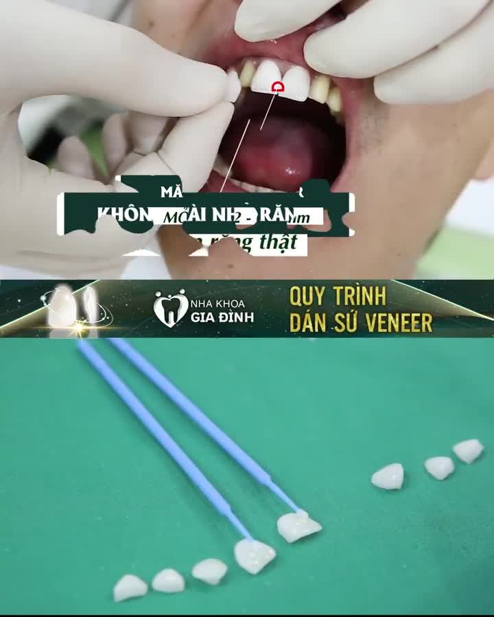 DÁN SỨ VENEER – GIẢI PHÁP LÀM ĐẸP RĂNG KHÔNG MÀI NHỎ CÓ 1-0-2
