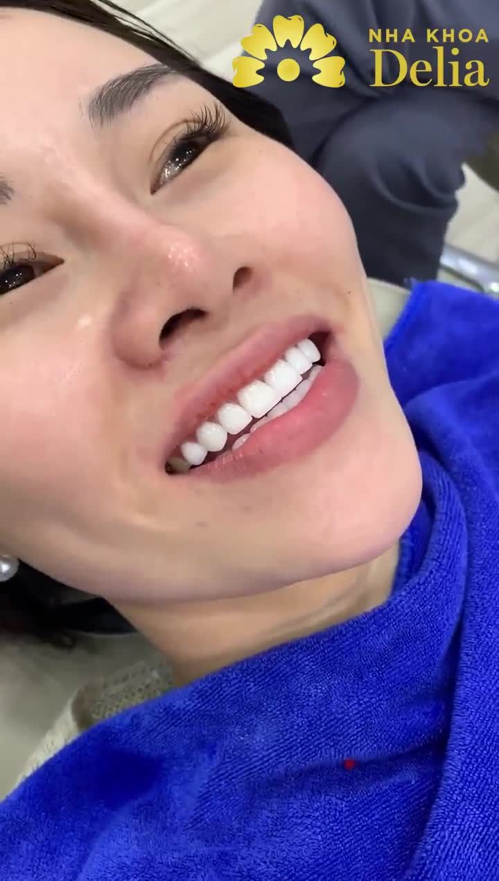 DÁN SỨ VENEER KHÔNG MÀI CHUẨN ĐỨC SIÊU BỀNSIÊU MỎNGSIÊU ĐẸP