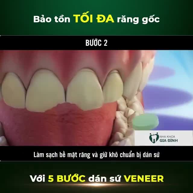 DÁN SỨ VENEER – LOẠI BỎ HOÀN TOÀN RĂNG SỨT MẺ, NHIỄM MÀU