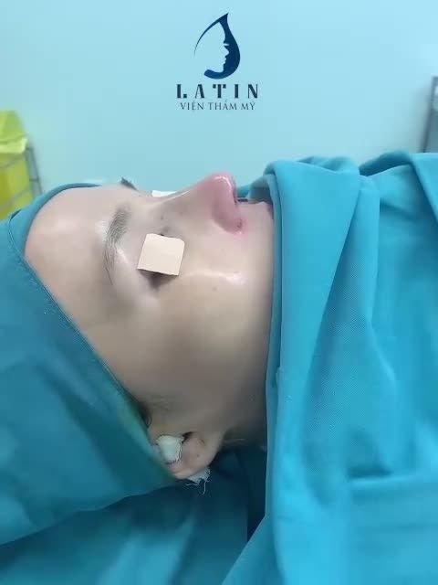 Dáng mũi Latin mềm mại cho bạn gái
