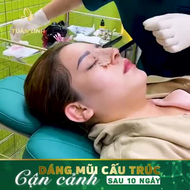 DÁNG MŨI SIÊU XINH SAU 10 NGÀY NÂNG CẤU TRÚC TẠI TUẤN LINH.