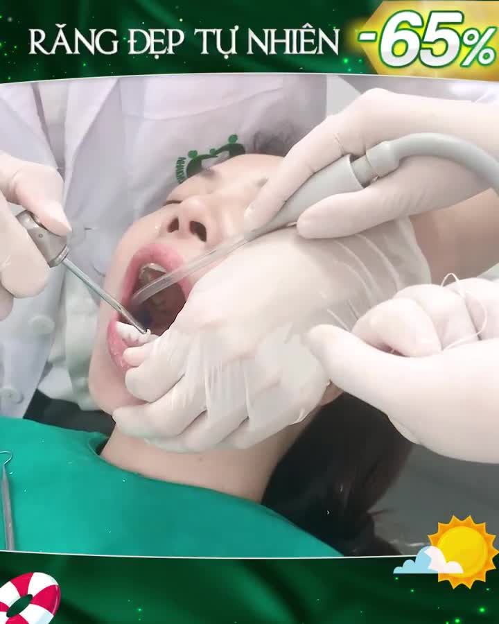 ĐÁNH BAY RĂNG XỈN MÀU BẰNG DÁN SỨ VENEER