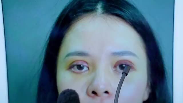 DR.HẢI LÊ TIẾP NHẬN GIẢI CỨU CA MÍ HỎNG TRONG THỜI ĐIỂM 0-12 NGÀY SAU PHẪU THUẬT MÍ TẠI CƠ SỞ KHÔNG UY TÍN DẪN ĐẾN THỦNG KẾT MẠC, SỤT CƠ, MÍ LỆCH