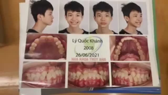 Gắn mắc cài điều trị giải cắn ngược cho bạn khách hàng Quốc Khánh.