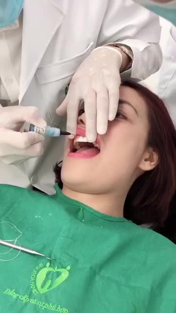 GẮN VENEER SỨ CAO CẤP CHO MỘT VỊ KH NỮ