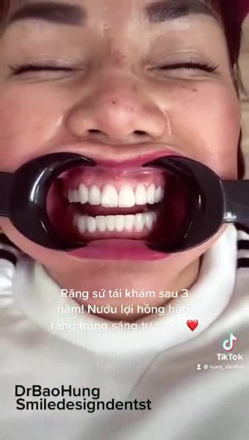 Hãy cùng nhìn ngắm nụ cười tươi đẹp của chị ấy sau 3 năm làm răng sứ!