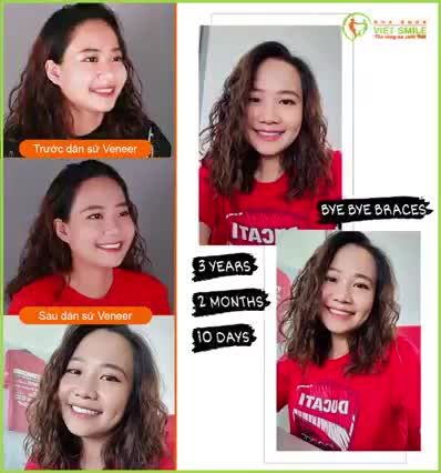 HOÀN THIỆN NỤ CƯỜI SAU NIỀNG RĂNG CÙNG VENEER
