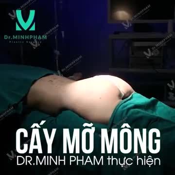 KẾT QUẢ CẤY MỠ MÔNG DR. MINH PHẠM THỰC HIỆN