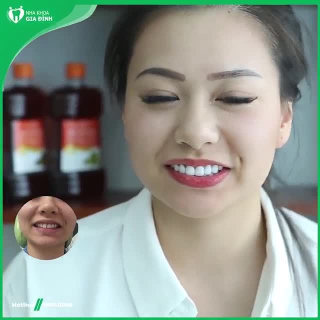 Kết quả sau khi làm răng sứ tại nha khoa Gia Đình
