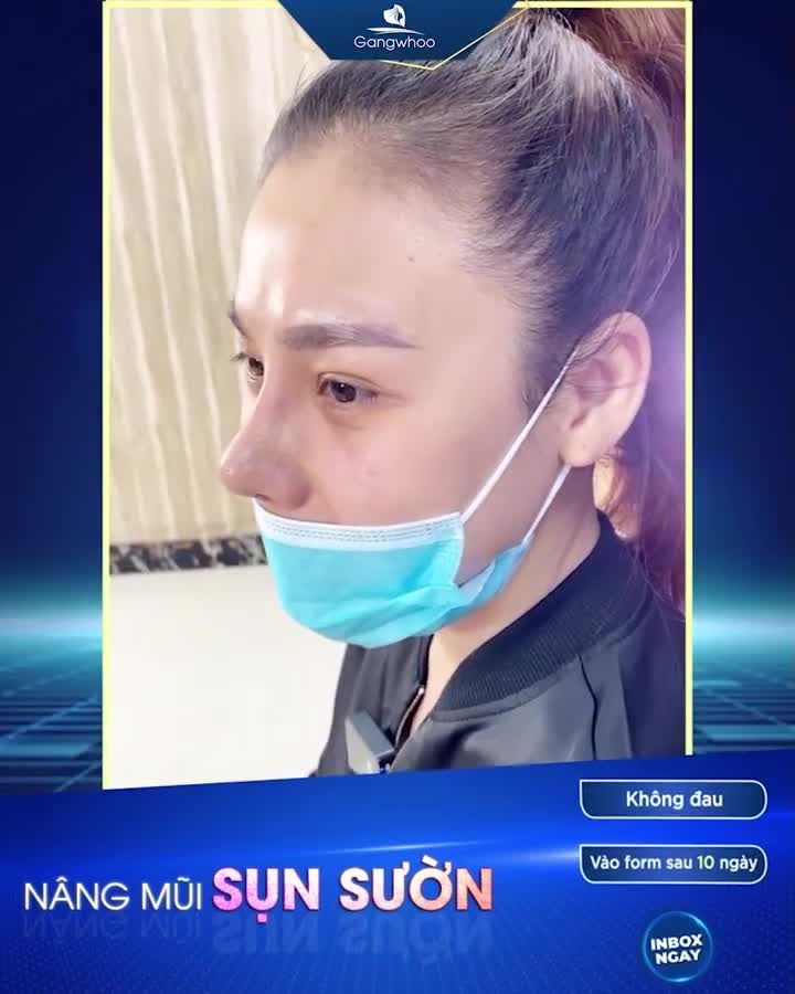 KHÁCH HÀNG NÂNG MŨI SAU 10 NGÀY ĐẸP NHƯ THẾ NÀO