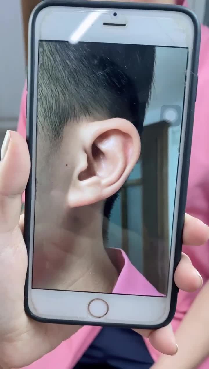 Khách hàng sử dụng dịch vụ Filler tai tài lộc để tạo hình dái tai to tròn, đầy đặn.