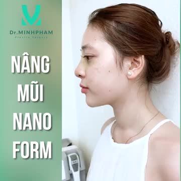 KHÁCH HÀNG TÁI KHÁM SAU KHI THỰC HIỆN NÂNG MŨI NANOFORM