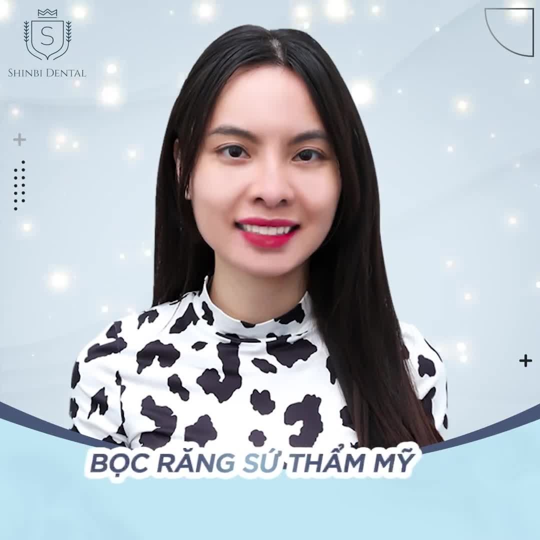 Khó có thể nhận ra được chị Mai Anh đã làm răng sứ vì màu sắc vô cùng tự nhiên.