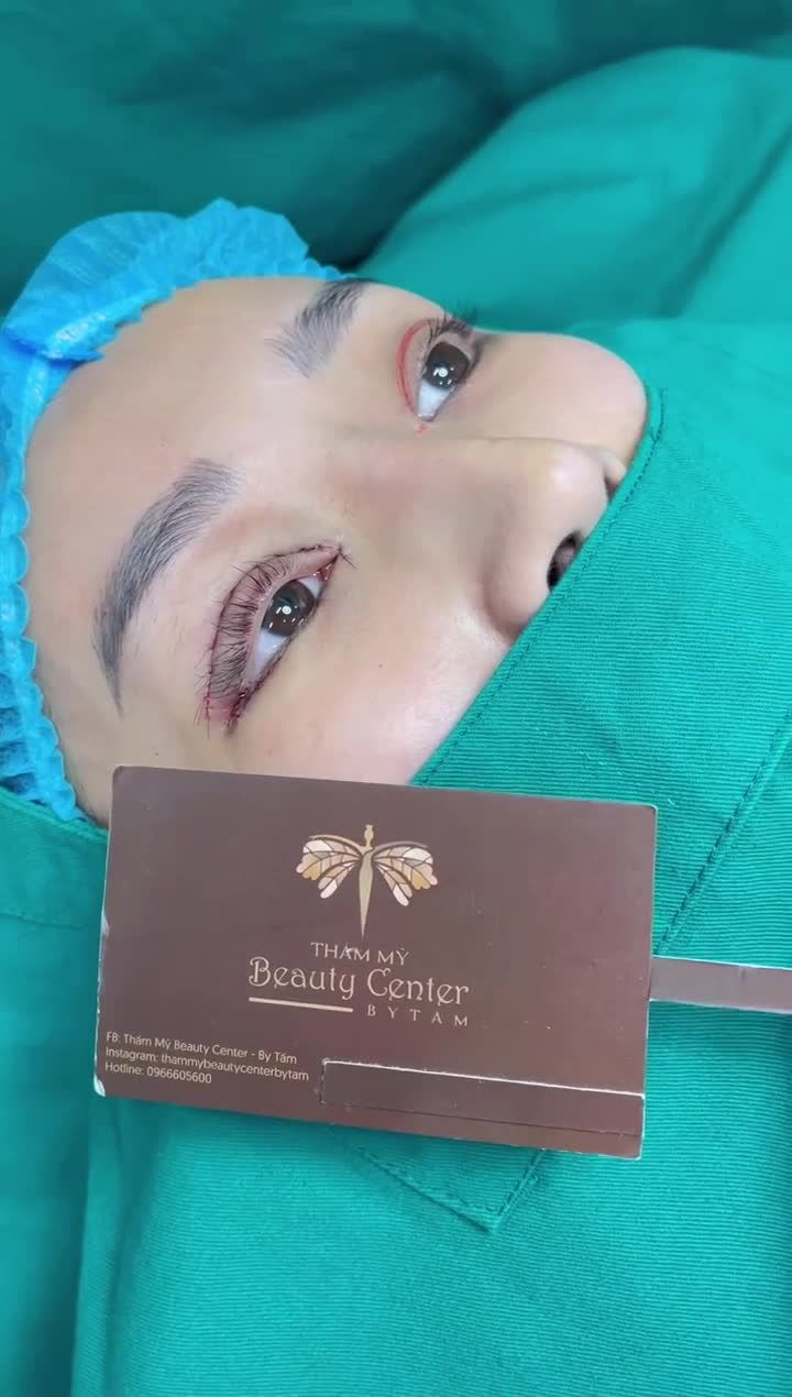 Khởi động tuần mới với khách hàng làm Full combo thẩm mỹ mắt: Cắt mí- Cấy mỡ- Mở hai góc- Hạ sếch. Mắt trước và sau làm đã khác biệt hoàn toàn.