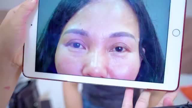 Lắng nghe chia sẻ của khách hàng từng cắt mí hỏng và hành trình tìm lại đôi mắt lành lặn, đẹp tự nhiên