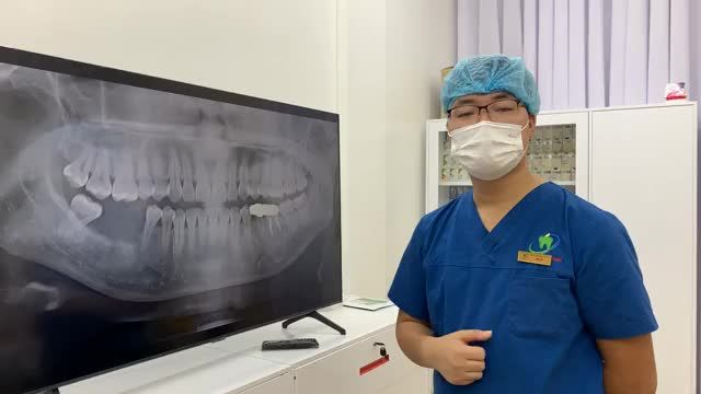 Lắp răng implant phục hình răng 46,47 bị mất cho khách hàng tại Nha Khoa Thuỳ Anh.