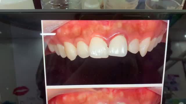 Lắp răng sứ thẩm mỹ cải thiện răng lệch lạc nhẹ, hình thể răng không đều cho chị khách hàng tại Nha Khoa Thuỳ Anh.