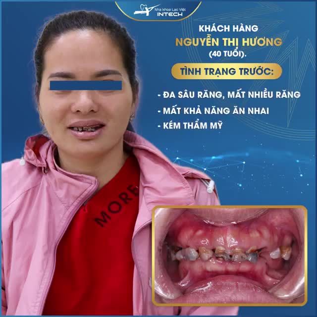 LẤY LẠI HÀM RĂNG CHẮC KHỎE BẰNG PHƯƠNG PHÁP TRỒNG RĂNG IMPLANT ALL - ON - 6 TẠI NHA KHOA LẠC VIỆT INTECH