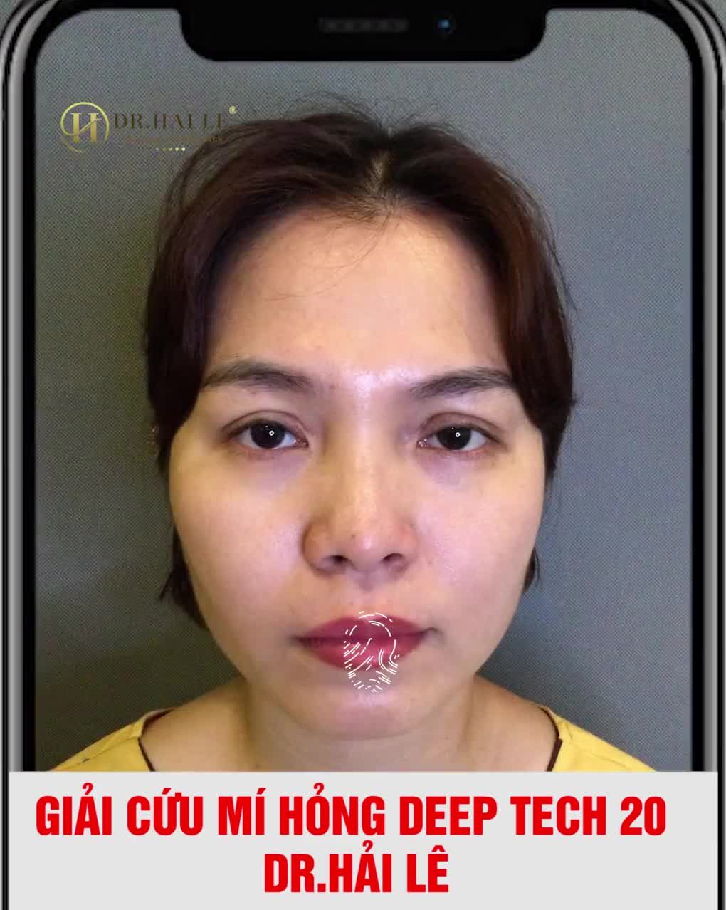 Mí cắt tại cơ sở không uy tín, bị hỏng do cắt chưa đúng kỹ thuật  lo lắng, tự ti, stress
