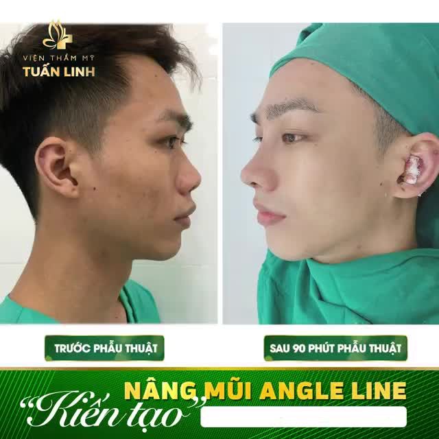 ''Mình mong muốn có một dáng mũi cao hài hòa, cân đối, và nhìn thật tự nhiên''