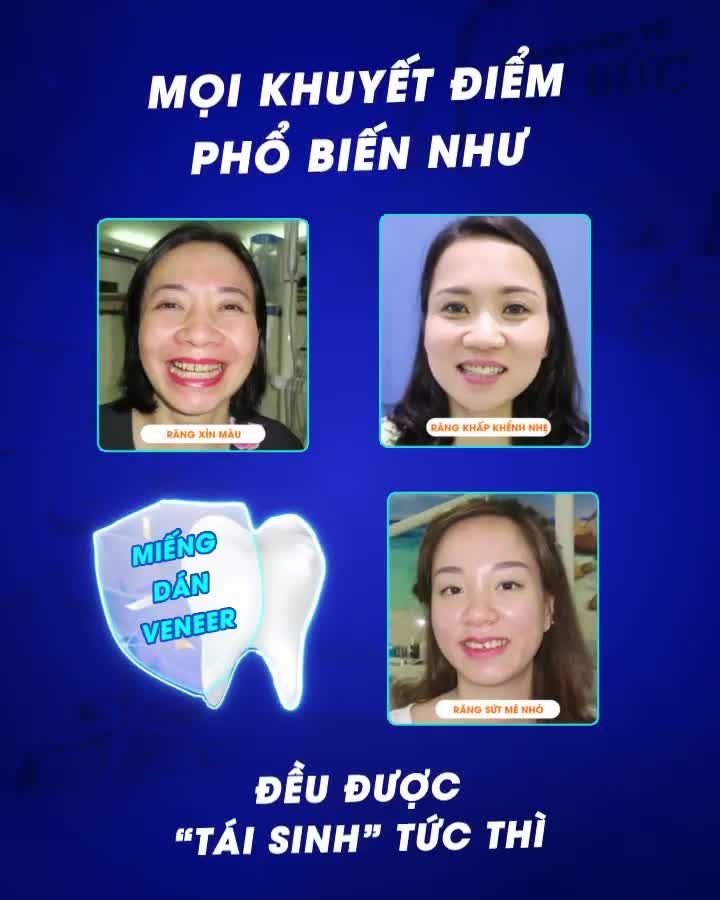 Mọi khuyết điểm: Răng xỉn màu, khấp khểnh nhẹ, sứt, mẻ nhỏ đều được “tái sinh” tức thì sở hữu ngay nụ cười cuốn hút từ ánh nhìn đầu tiên với phương pháp dán sứ Veneer.