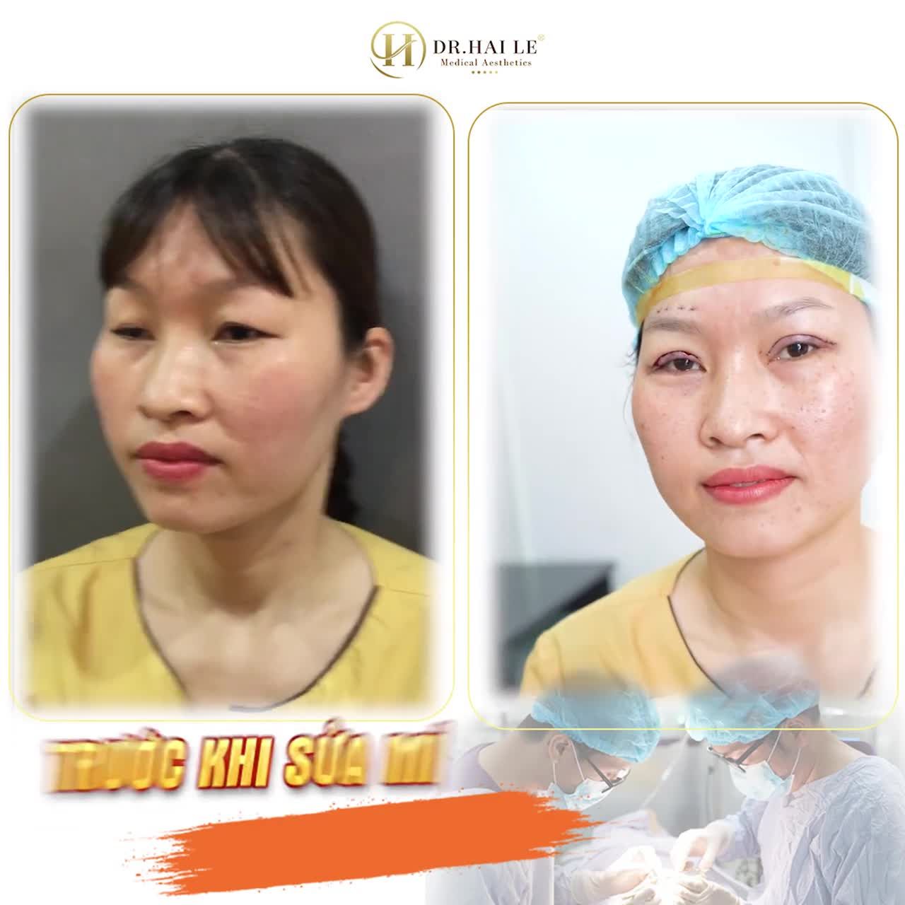 Mỗi người mỗi tình trạng mí lỗi, hỏng khác nhau do thực hiện cắt mí chưa đúng kỹ thuật trước đó tại cơ sở thẩm mỹ khác, thế nhưng điểm chung là