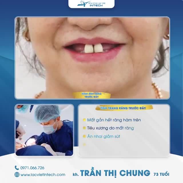 MỘT CA PHỤC HỒI RĂNG HÀM TRÊN THẦN TỐC NHỜ TRỒNG RĂNG IMPLANT ALL-ON-6