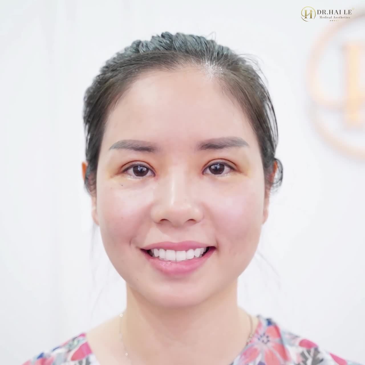 Một vài lời đồn: Cắt mí đau lắm, lại nhìn "giả trân", tốn tiền, mất thời gian mà lại không đẹp. KHÔNG HỀ NHA!