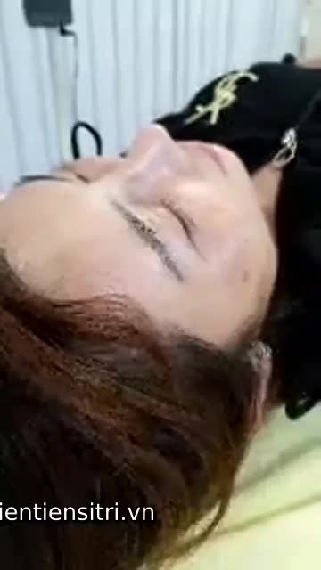 Mũi cao xinh thon gọn của chị khách hàng sau PT nâng mũi Ashape 2 tuần. Các bạn cùng chiêm ngưỡng dáng mũi nhé!