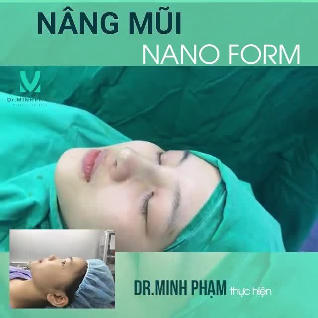 MŨI NANOFORM CỰC XINH – GHI HÌNH CỰC ĐỈNH KẾT QUẢ CA NÂNG MŨI NANOFORM DO EKIP DR. MINH PHAM THỰC HIỆN
