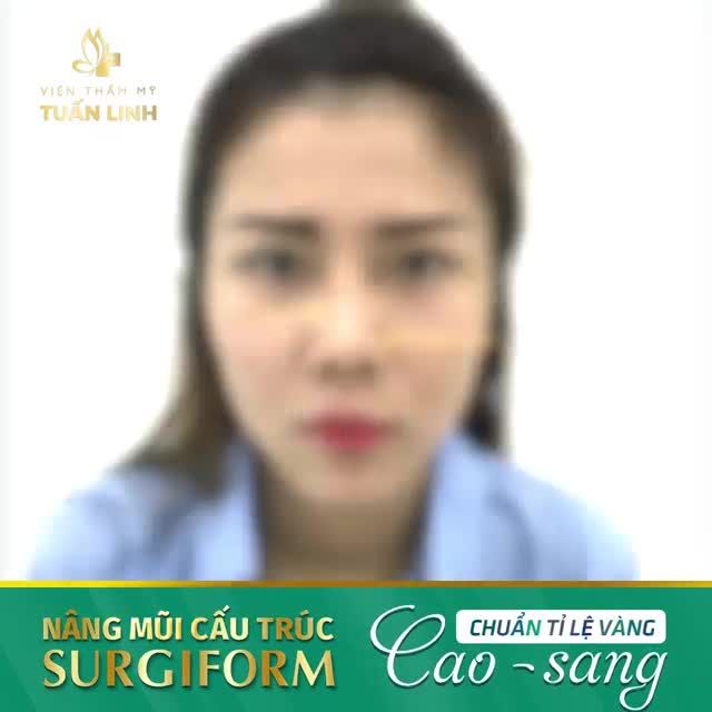 Mũi thấp tẹt - Mũi hếch - Mũi lệch gây ra nhiều trở ngại