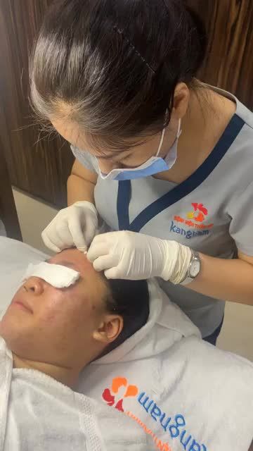 Mụn TRỨNG CÁ Lây lan "mất kiểm soát" do không trị tận gốc