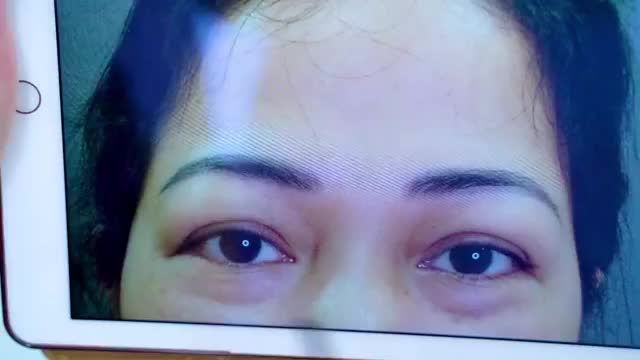 Nâng cung mày giúp chị em tuổi trung niên xóa bỏ sụp mí già nua để sở hưu đôi mắt rạng rỡ trẻ trung như ngày nào