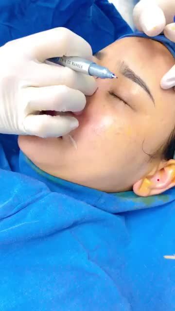 NÂNG MŨI CẤU TRÚC - MŨI ĐẸP TINH TẾ TỪNG ĐƯỜNG NÉT