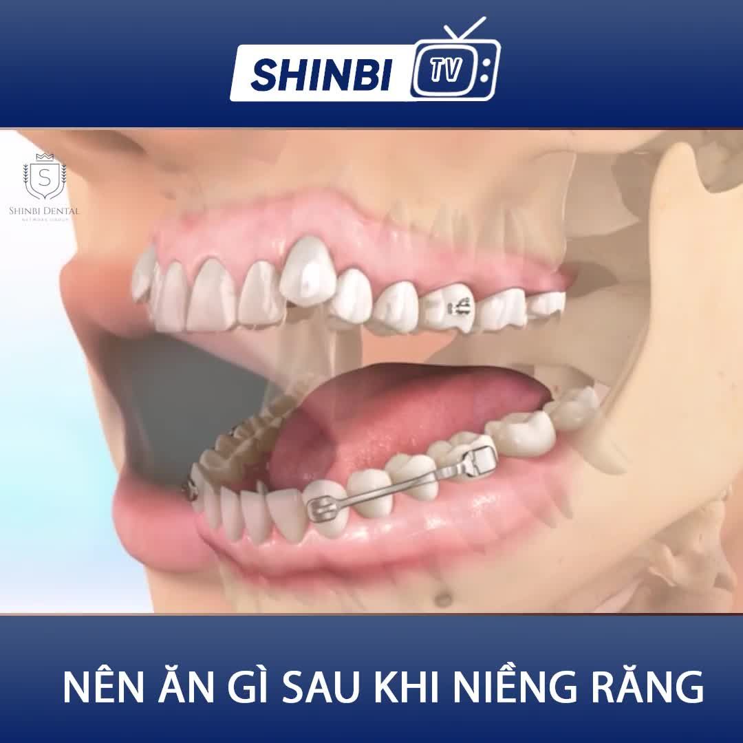 Nên ăn gì sau khi niềng răng.
